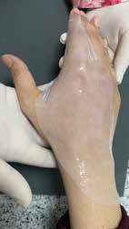 Bacterial Cellulose